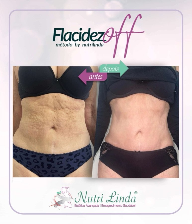Antes e depois - Tratamento para flacidez