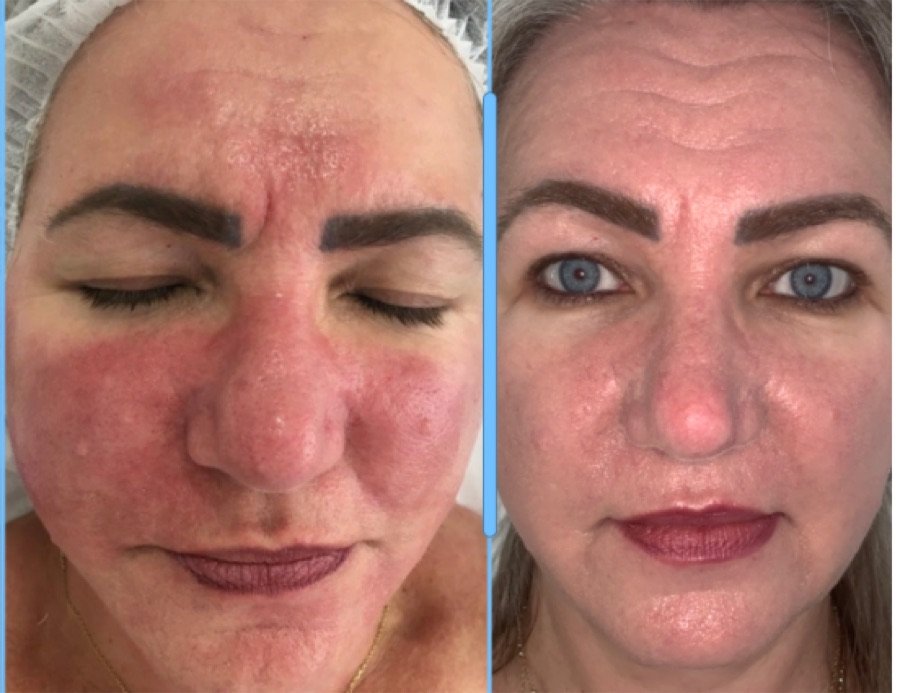 Antes e depois - Tratamento para rosácea