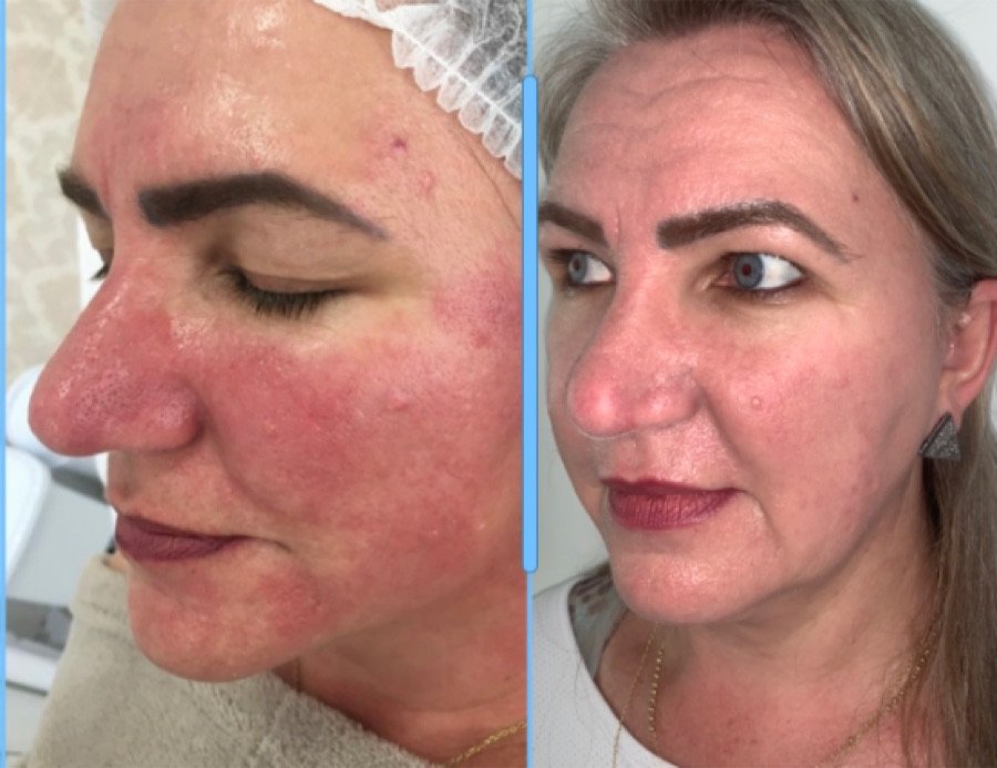 Antes e depois - Tratamento facial