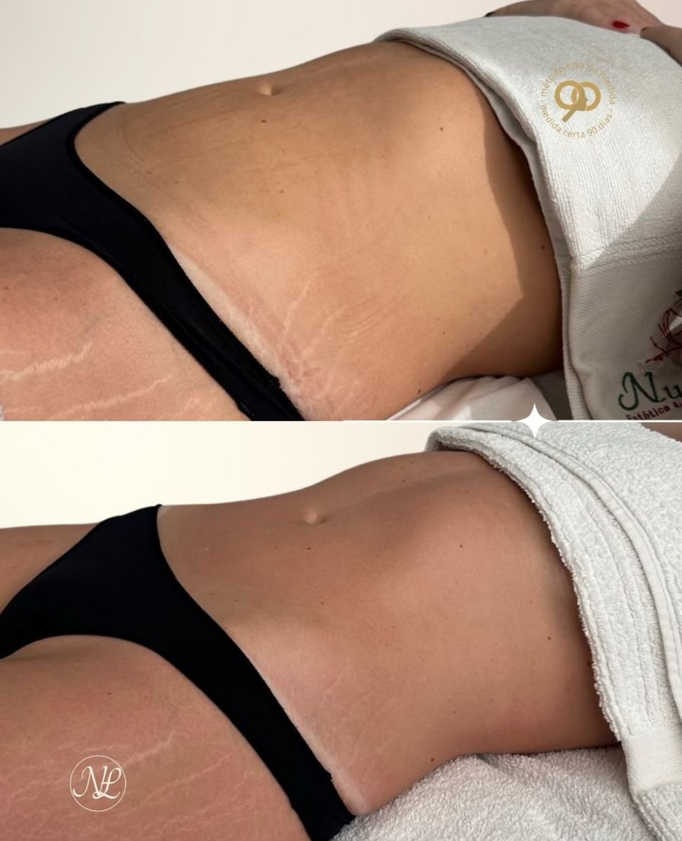 Antes e depois -