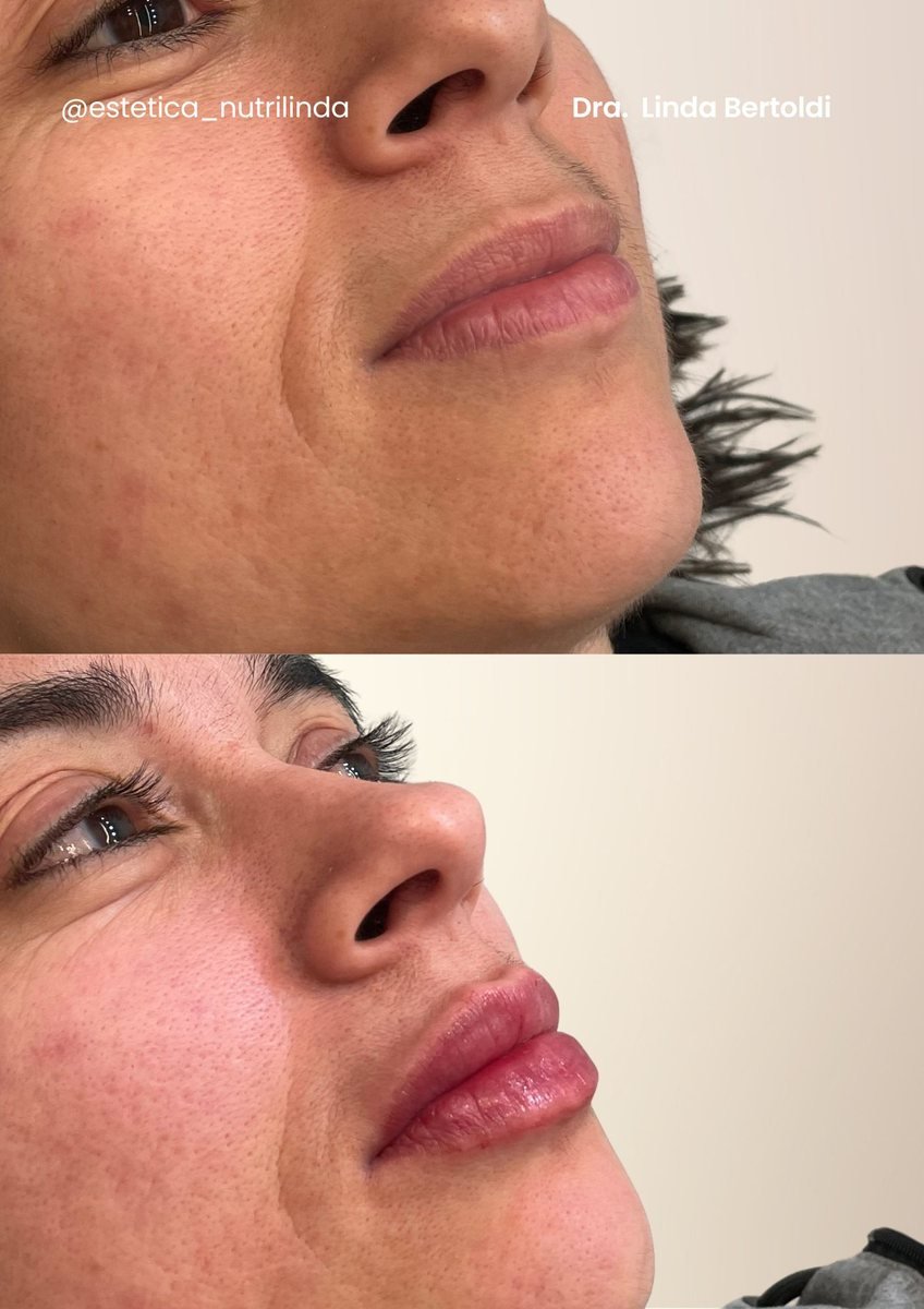 Antes e depois -