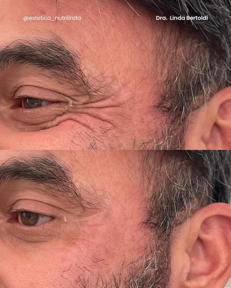 Antes e depois - Club do Botox®