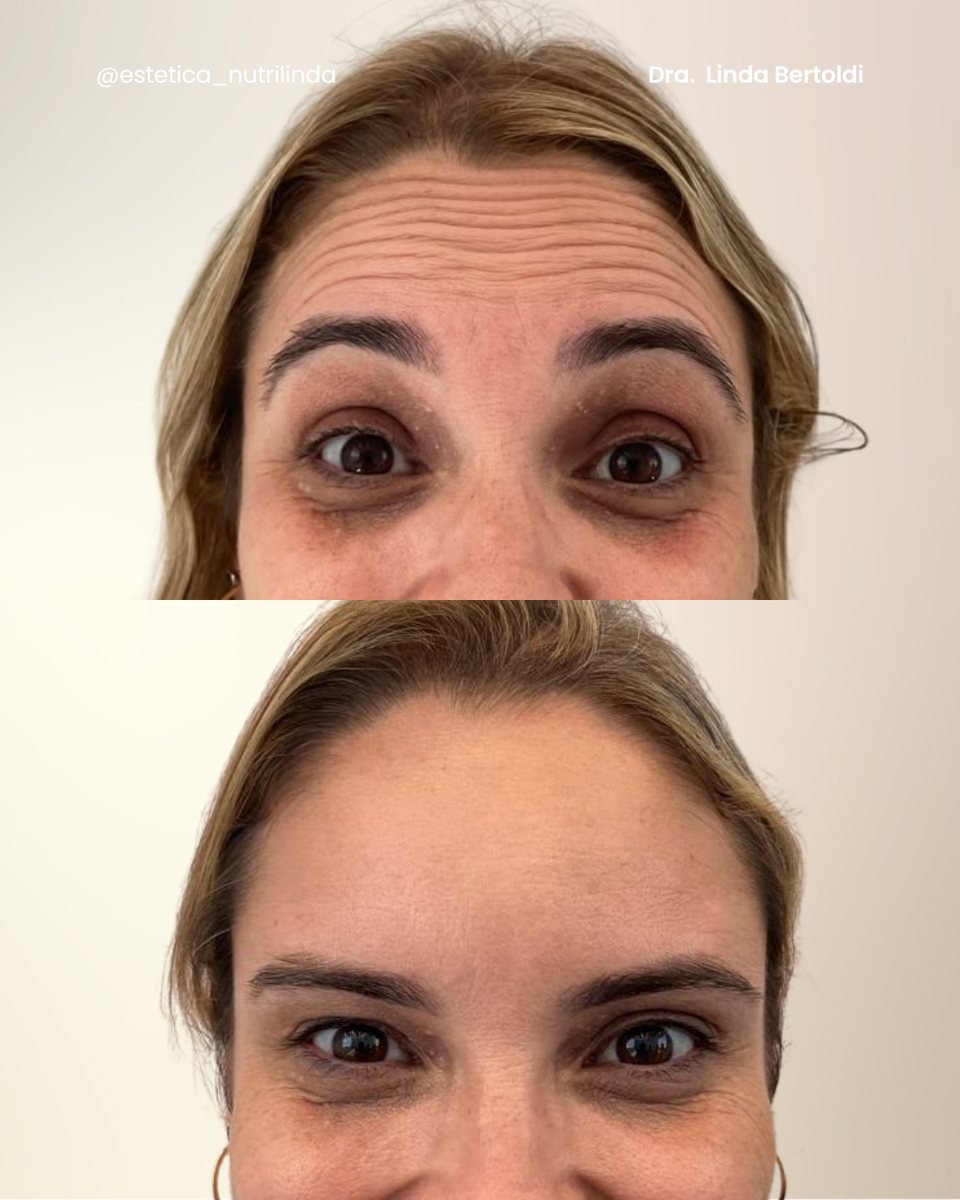 Antes e depois - Club do Botox®