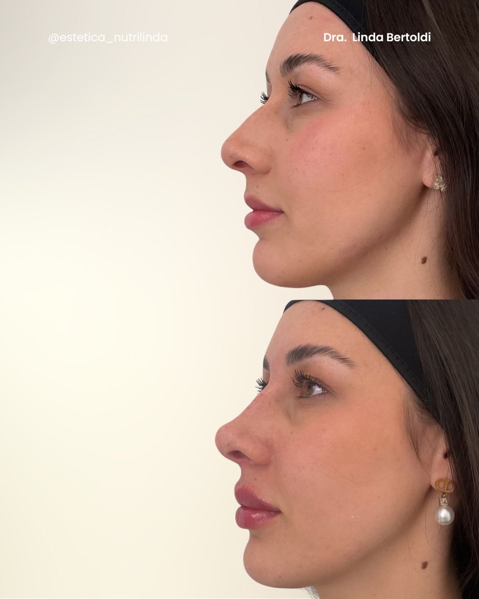 Antes e depois - NL Profile®