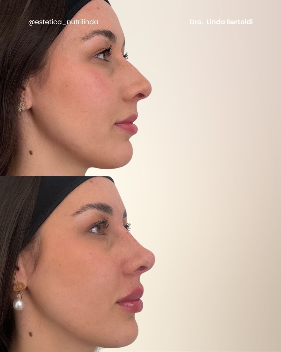 Antes e depois - NL Profile®
