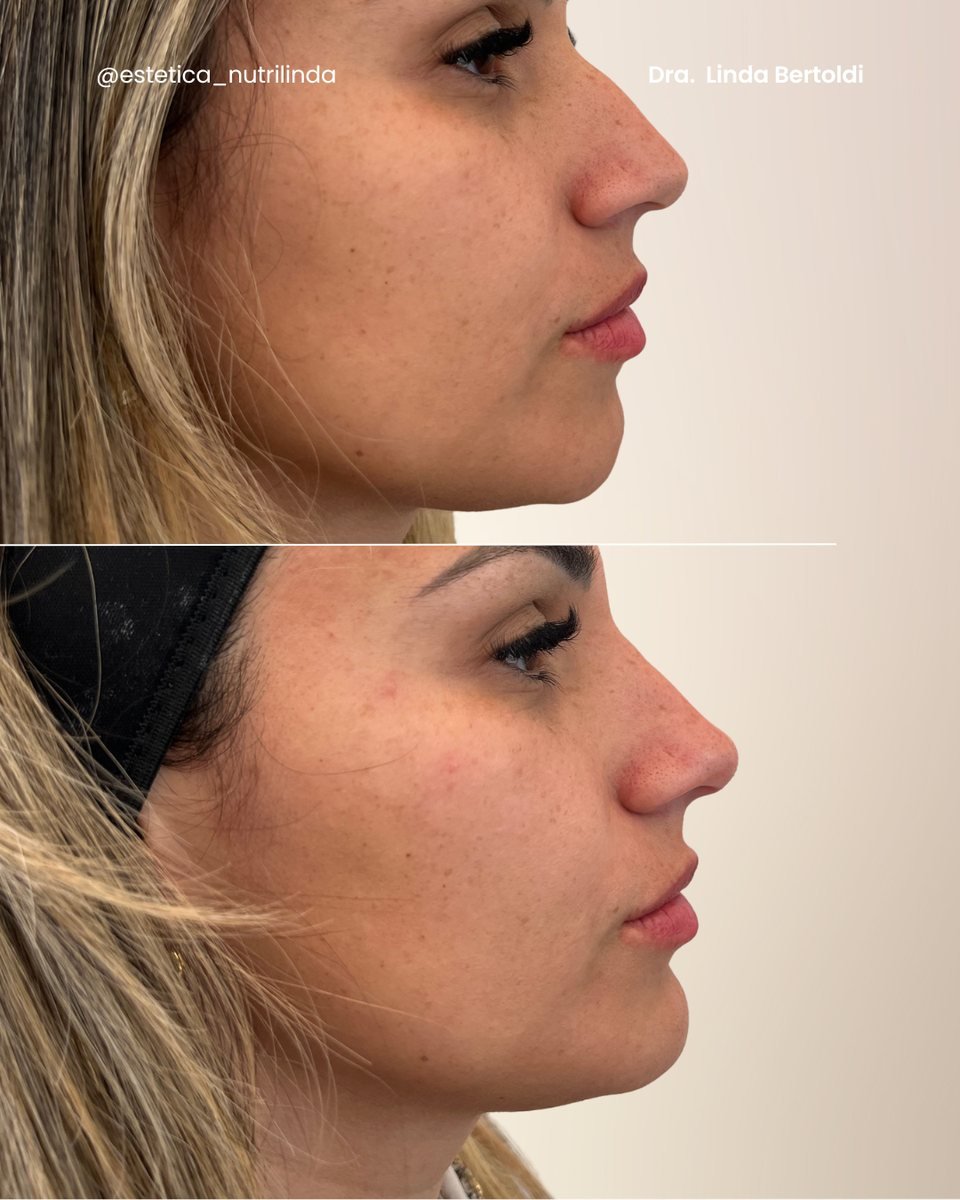 Antes e depois - Preenchimento Queixo